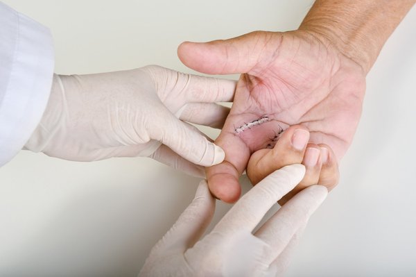 Chirurgien main aubagne : soulagez vos douleurs rapidement